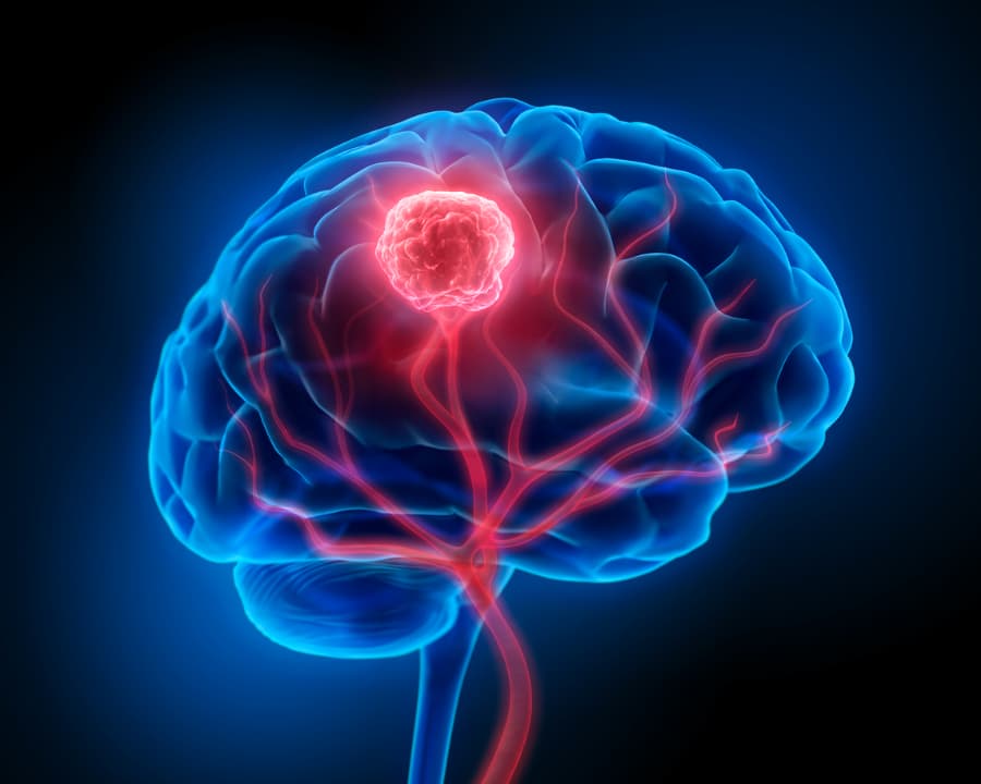 Brain MRI or CT scan illustration depicting brain tumor in red