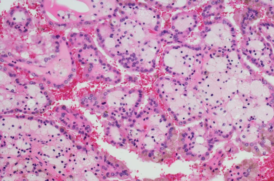 Cancer cells found in kidney, as seen under microscope