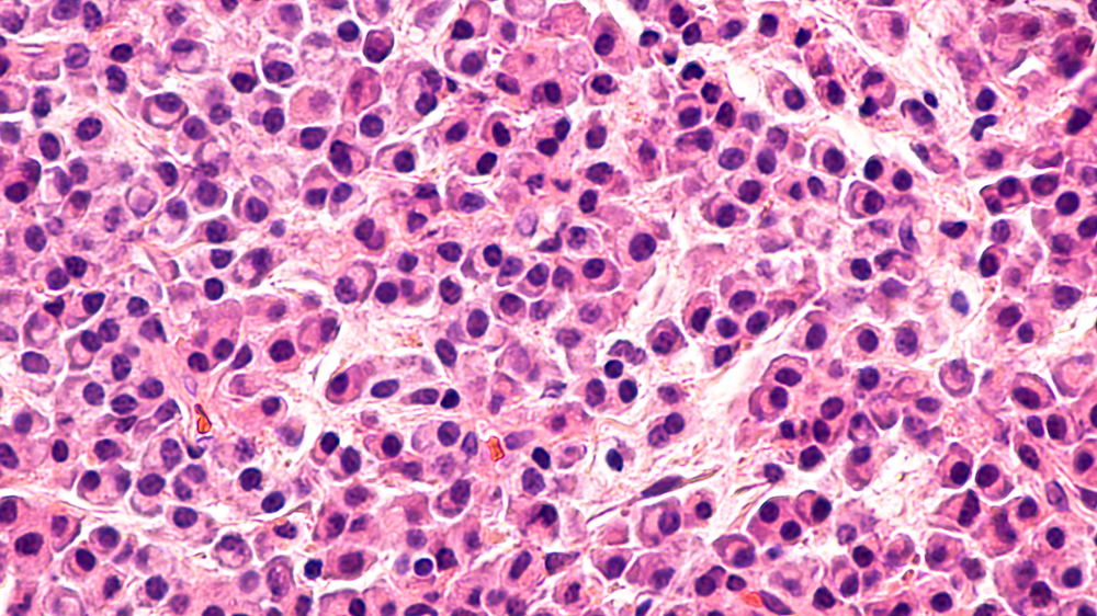 Diagnostic image of multiple myeloma