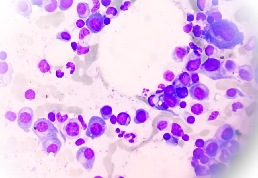 Diagram of bone marrow suggesting multiple myeloma