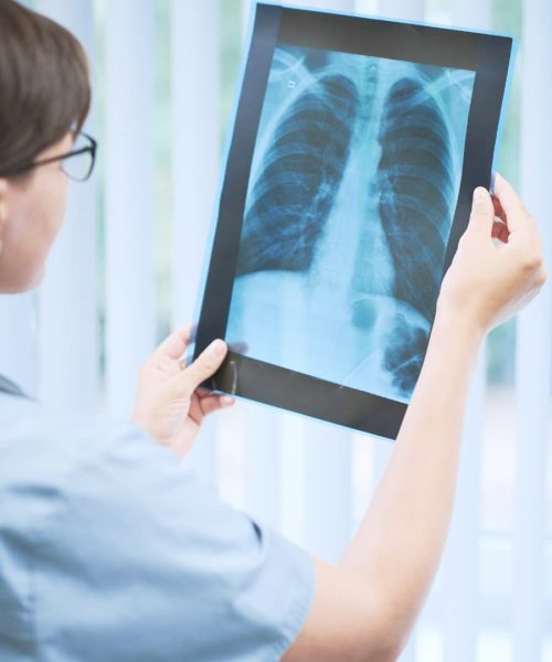 doctor-looking-at-an-x-ray-for-lung-cancer
